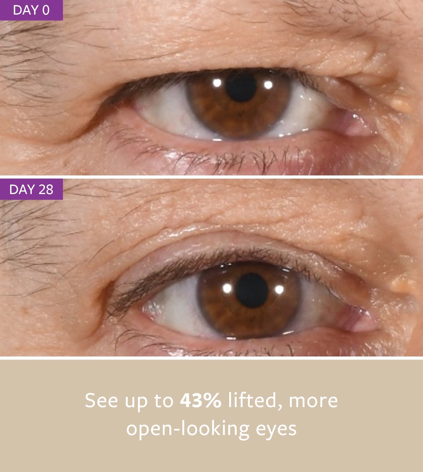 non-surgical EYELID LIFT freezeframeau