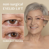 non-surgical EYELID LIFT freezeframeau