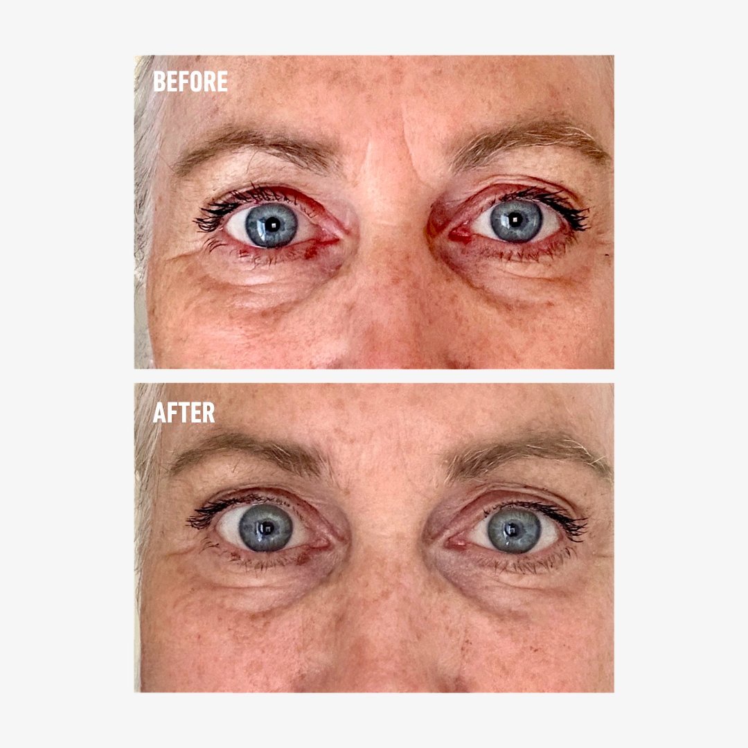 freezeframe 48 HOUR WRINKLE FREEZE anti-wrinkle treatment before and after results frown lines between brows