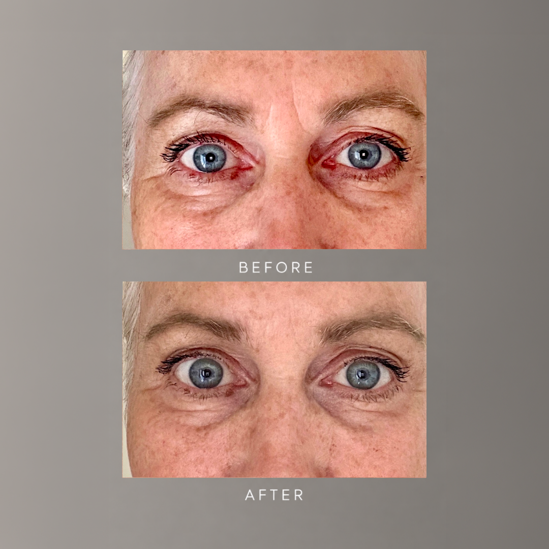 freezeframe 48 HOUR WRINKLE FREEZE anti-wrinkle treatment before and after results frown lines between brows
