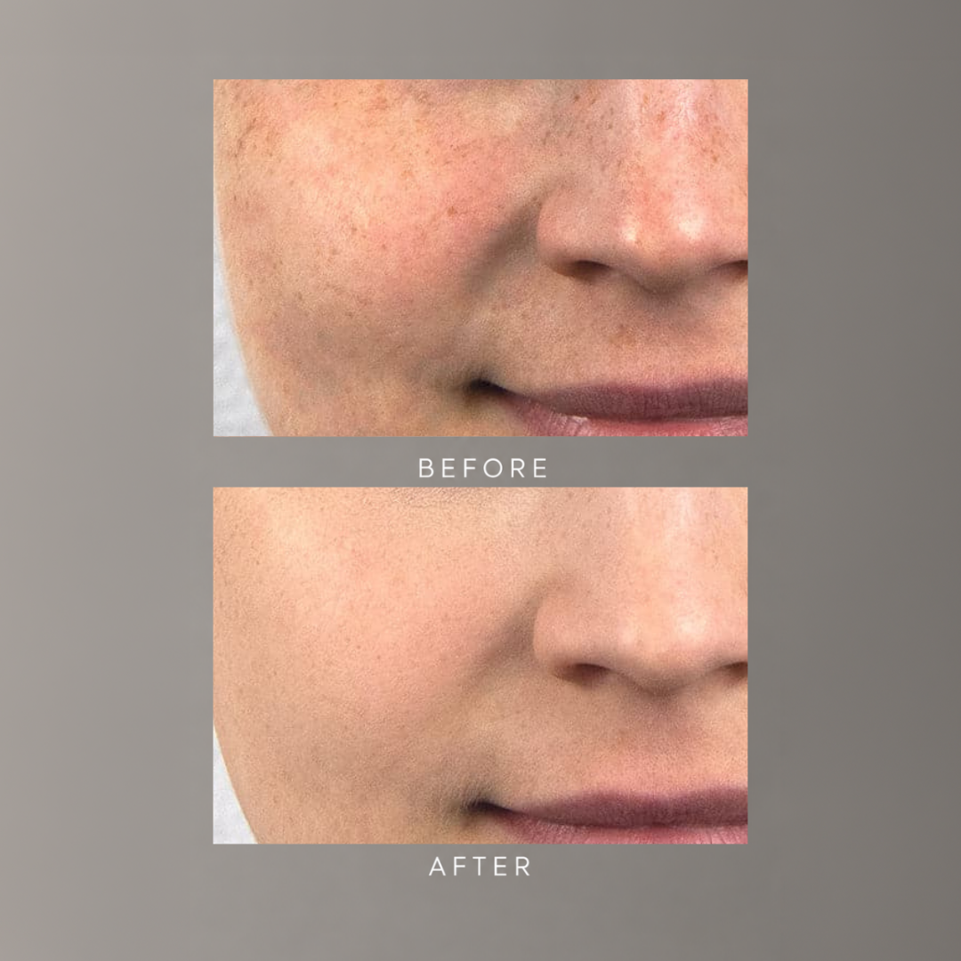 freezeframe BB BLUR before and after results showing instant blurring of imperfections and even skin tone