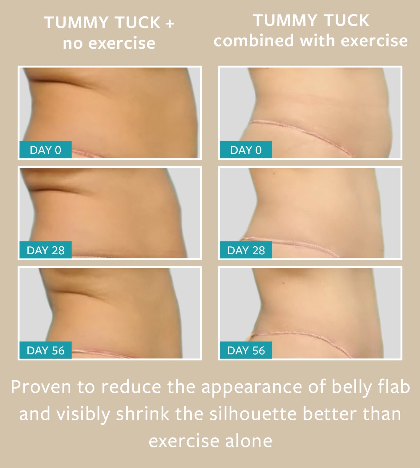 TUMMY TUCK freezeframeau