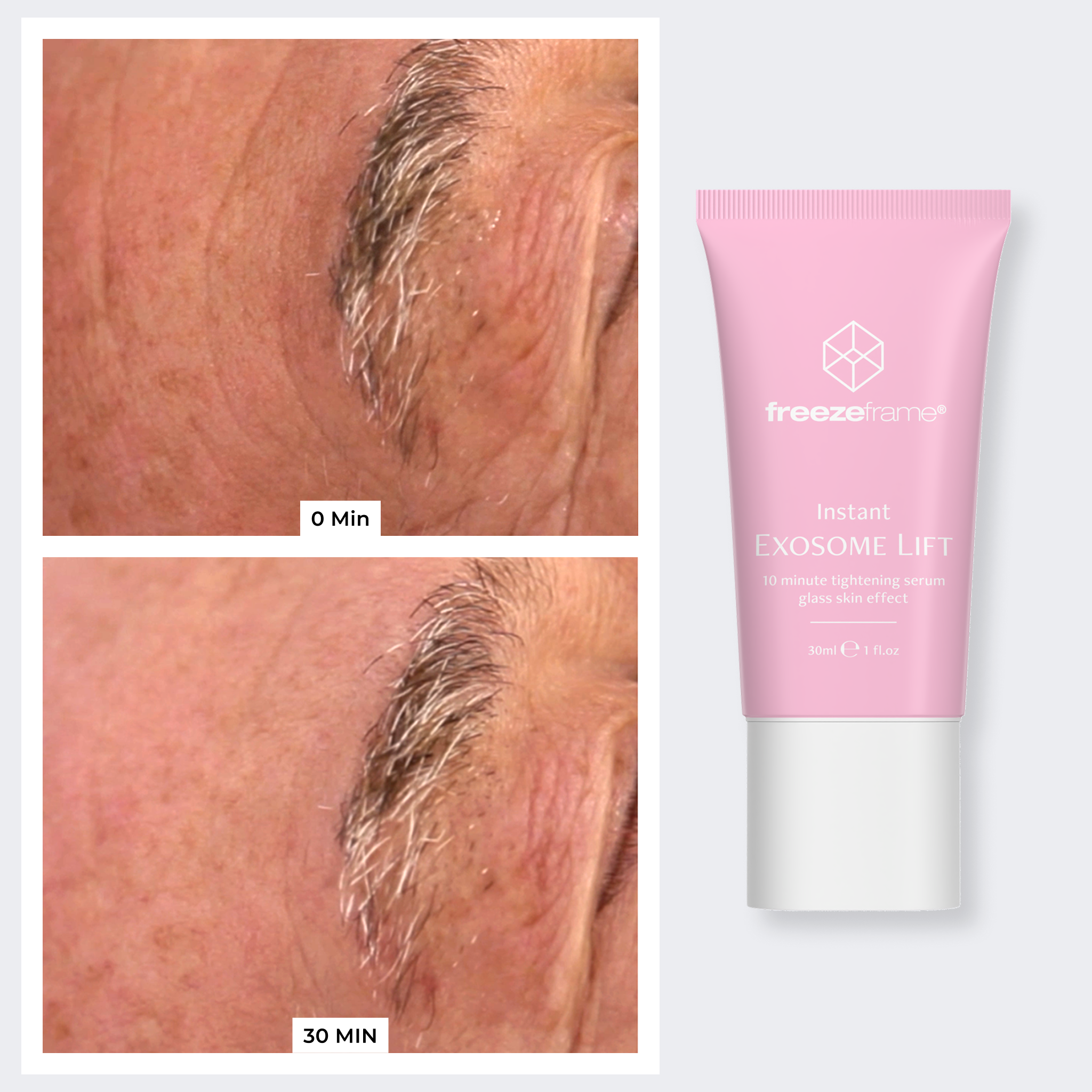 FACE LIFT & REJUVENATION SYSTEM freezeframe