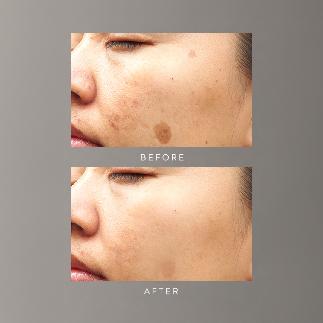 freezeframe PIGMENT CLEAR before and after results showing visible reduction in dark spots and skin pigmentation, and brighter, more even complexion