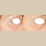 freezeframe PRO-COLLAGEN SUNCEUTICAL before and after results showing visible reduction in wrinkles and more lifted looking skin