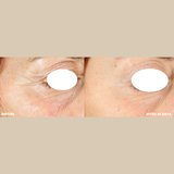 freezeframe PRO-COLLAGEN SUNCEUTICAL before and after results showing visible reduction in wrinkles and more lifted looking skin