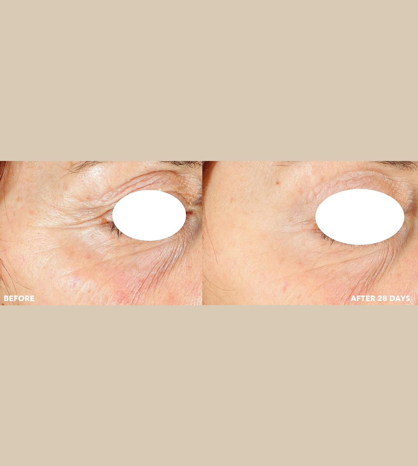 freezeframe PRO-COLLAGEN SUNCEUTICAL before and after results showing visible reduction in wrinkles and more lifted looking skin