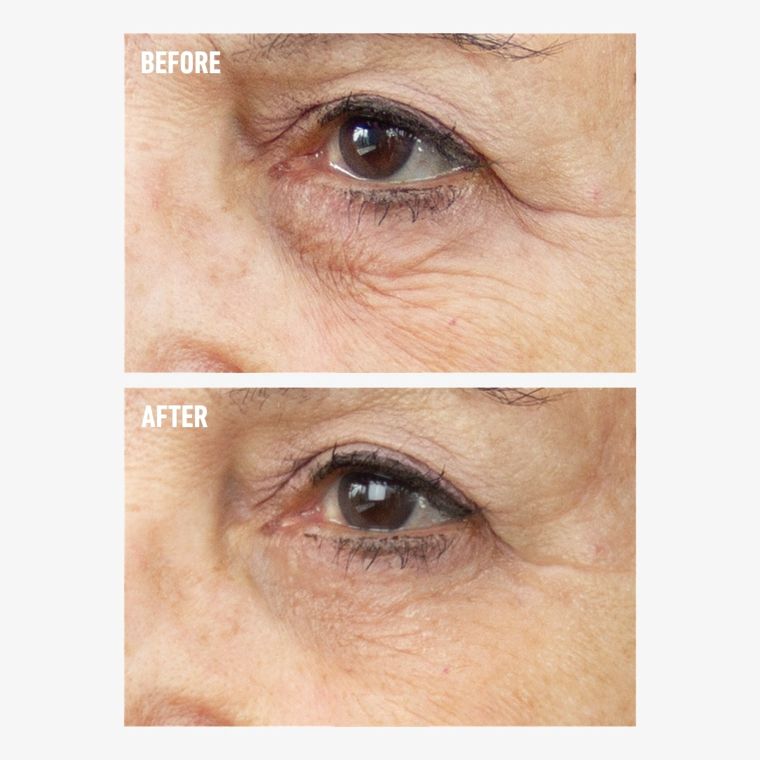 Before and after showing the appearance of under-eye wrinkles with freezeframe REVITALEYES