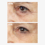 Before and after showing the appearance of under-eye wrinkles with freezeframe REVITALEYES