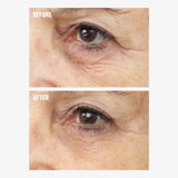 Before and after showing the appearance of under-eye wrinkles with freezeframe REVITALEYES