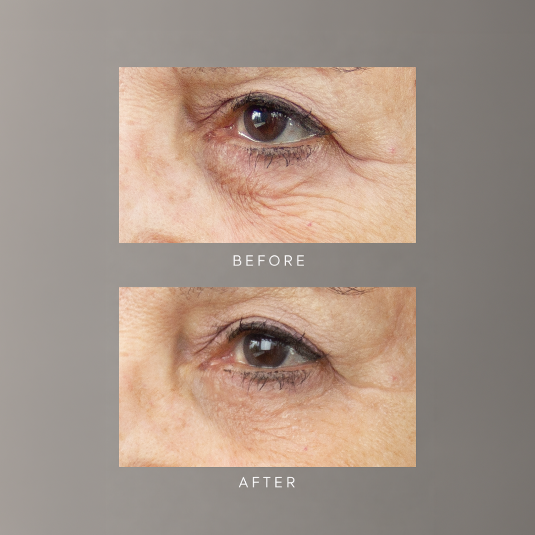 Before and after showing the appearance of under-eye wrinkles with freezeframe REVITALEYES