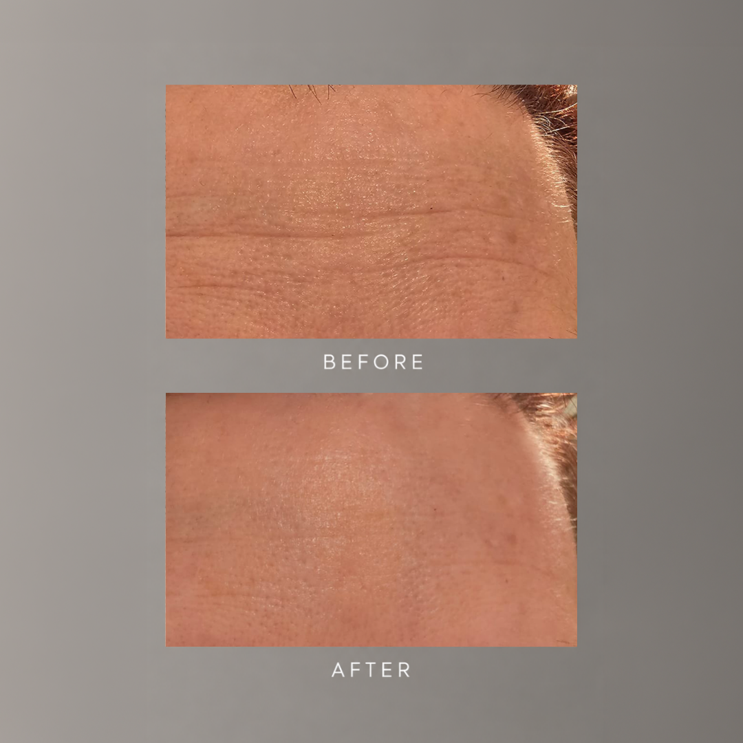 freezeframe WRINKLE BLOCK before and after results showing visible reduction in wrinkles and smoother, younger-looking skin