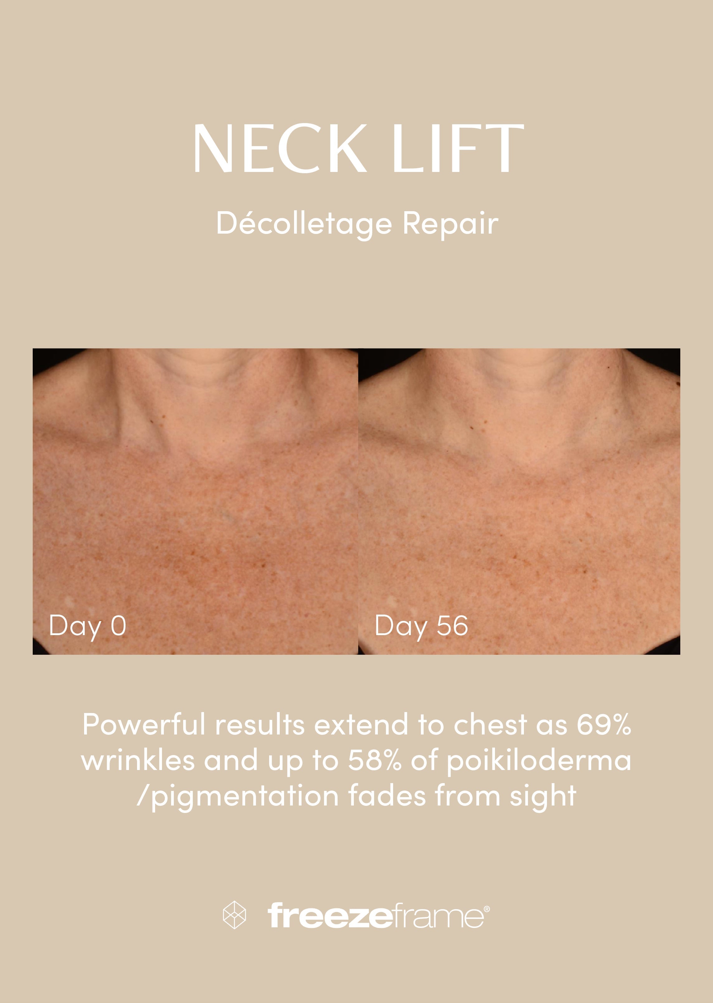 NECK LIFT Freezeframe