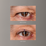 freezeframe non-surgical EYELID LIFT lifting serum before and after results for lifted, more open-looking upper eyelid