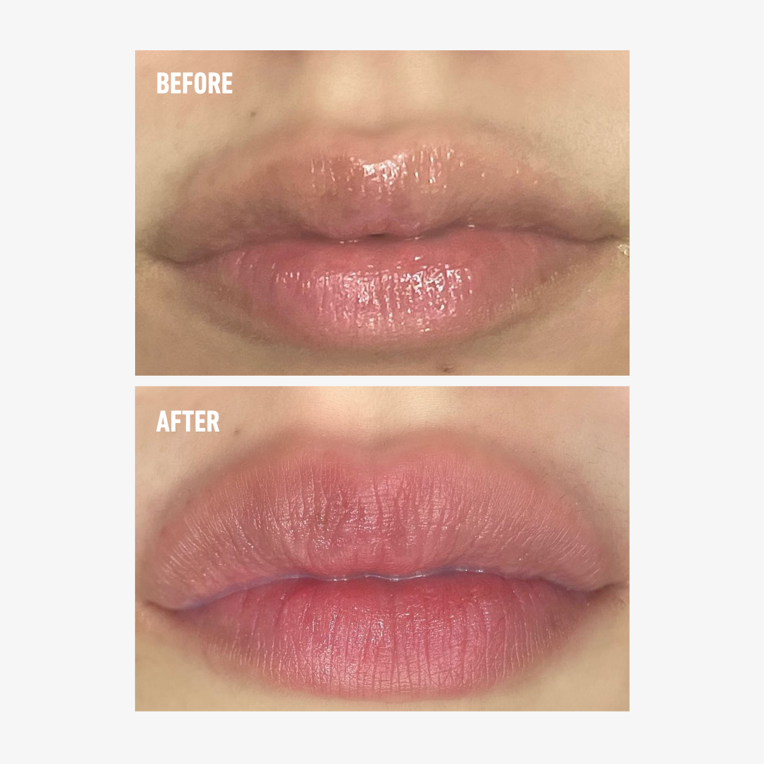 Before and after results using freezeframe LIP INJECTION showing visibly fuller, plumper-looking lips