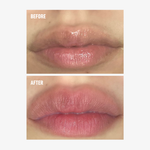 Before and after results using freezeframe LIP INJECTION showing visibly fuller, plumper-looking lips