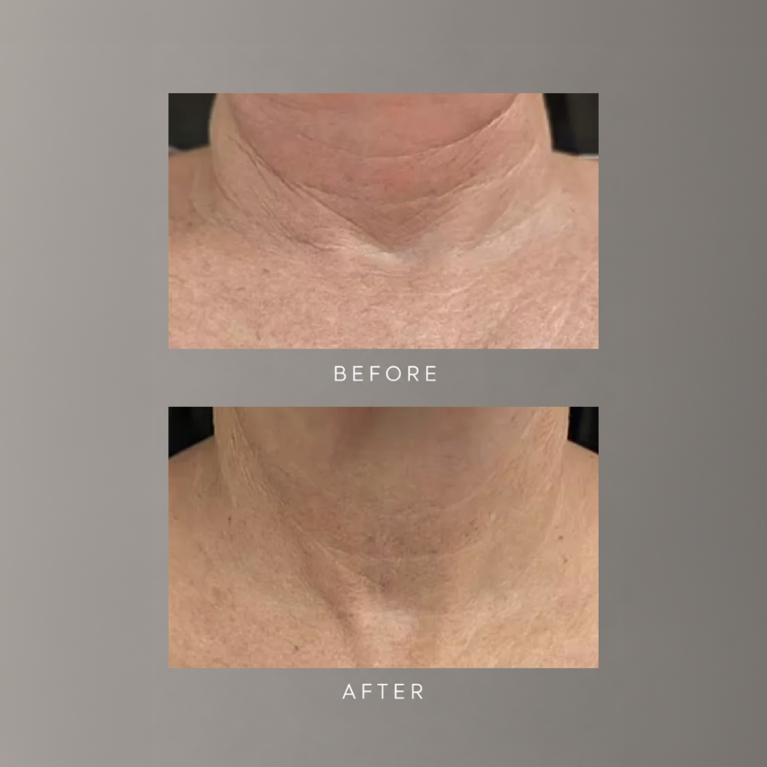 freezeframe NECK LIFT before and after comparison showing visibly smoother, firmer-looking skin on the neck and décolletage, with reduced appearance of horizontal neck lines and wrinkles in the after image.