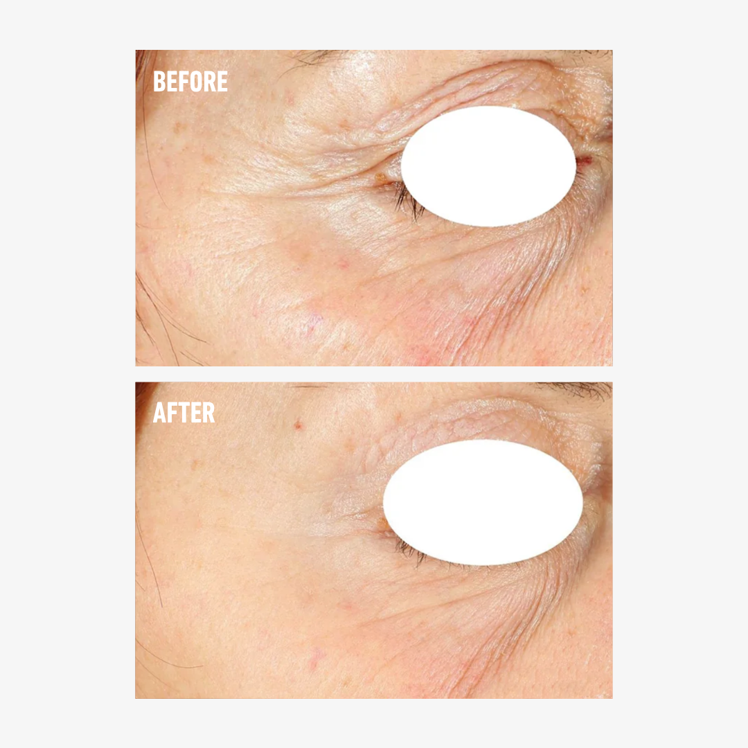 freezeframe PRO-COLLAGEN SUNCEUTICAL before and after comparison showing the eye area with visibly smoother skin and reduced appearance of crow's feet, fine lines and wrinkles.