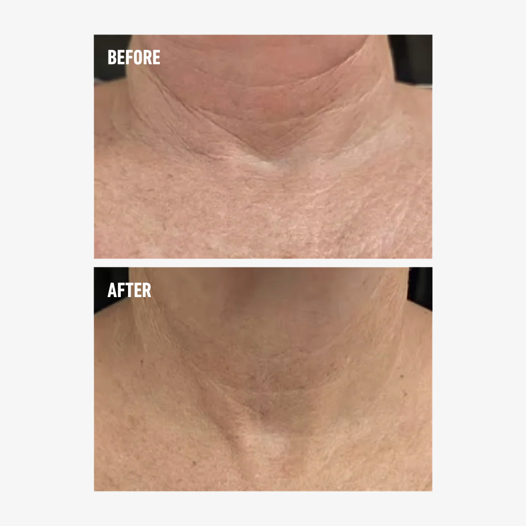 freezeframe NECK LIFT before and after showing visibly smoother-looking neck and décolletage skin
