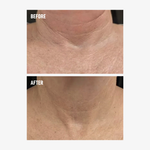 freezeframe NECK LIFT before and after showing visibly smoother-looking neck and décolletage skin