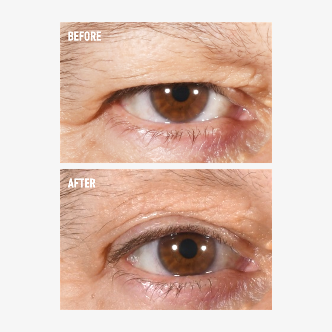 freezeframe non-surgical EYELID LIFT lifting serum before and after results for lifted, more open-looking upper eyelid